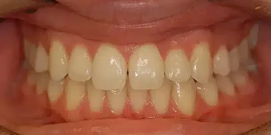 Clearwater dental associates cosmetic dental whitening patient before teeth whitening