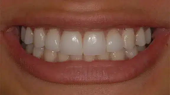 Clearwater dental associates cosmetic dental whitening patient after teeth whitening