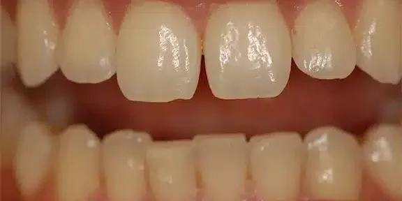 clearwater dental associates dental whitening patient nick before teeth whitening