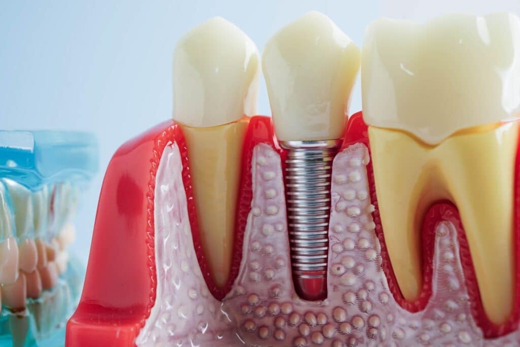 dental implants clearwater